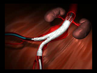 Τρισδιάστατη απεικόνιση τοποθετημένου ενδομοσχεύματος στην κοιλιακή αορτή