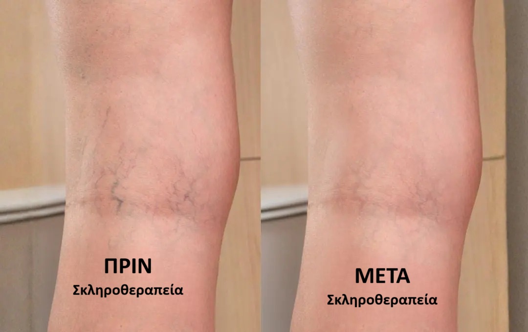 Πριν και μετά τη σκληροθεραπεία αφρού