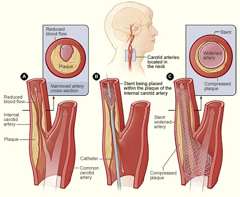 Σχηματική απεικόνιση τοποθέτησης stent στην έσω καρωτίδα