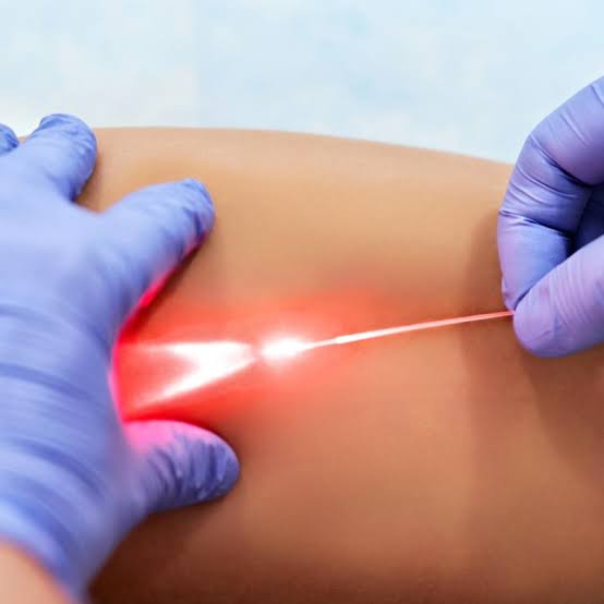 Ενδοαυλική θεραπεία με οπτική ίνα laser (EVLA)