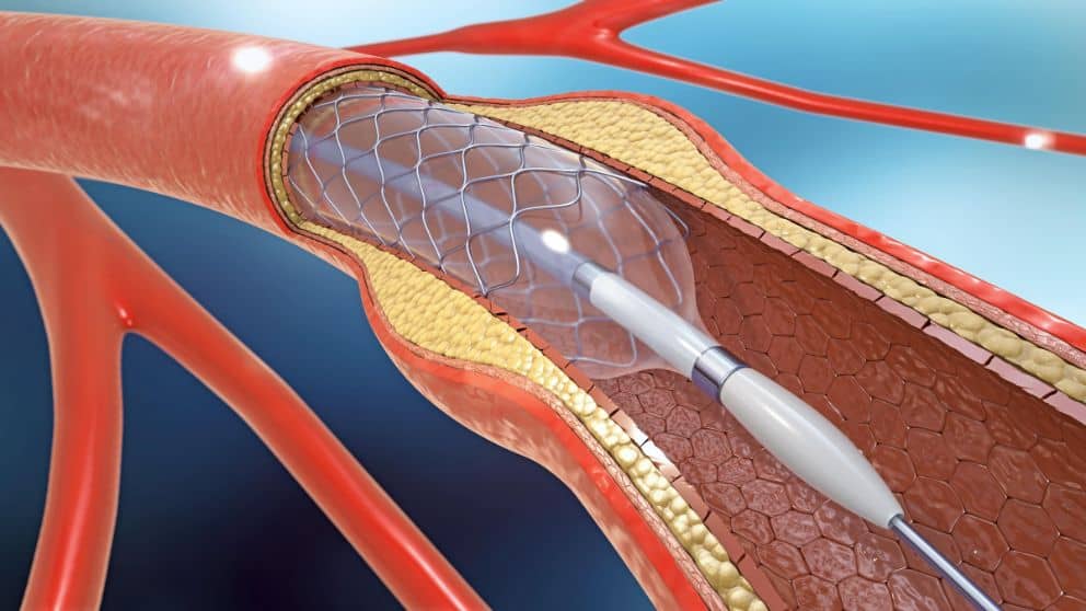Αγγειοπλαστική με μπαλόνι και τοποθέτηση stent σε αρτηρία