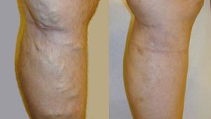 φλεβική ανεπάρκεια - κιρσοί